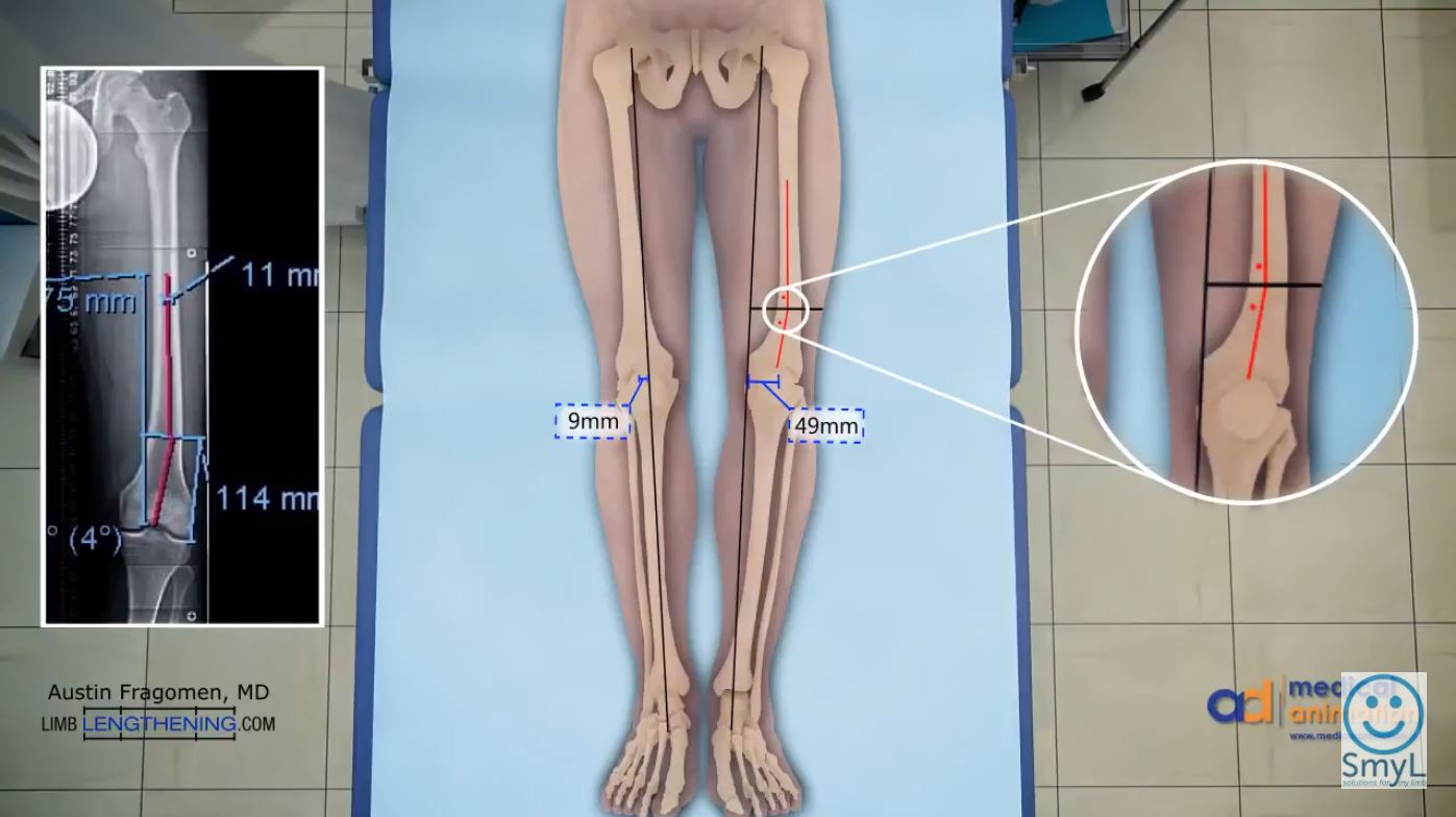 Femur Lengthening