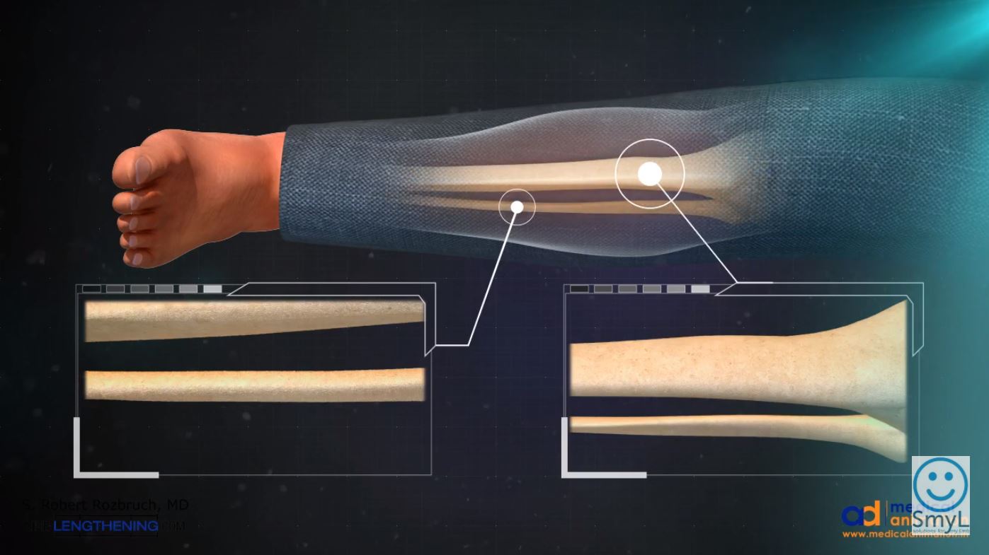 Tibia Lengthening