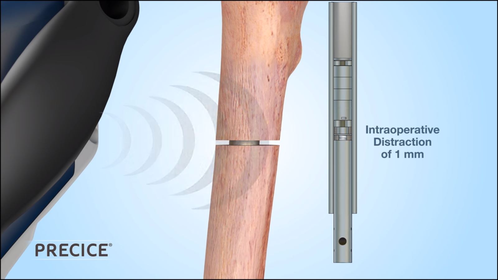 Internal Lengthening 